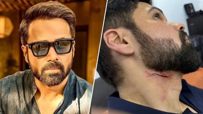 Emraan Hashmi Suffers Injury On Sets Of Goodachari 2 In Hyderabad, Photo Goes Viral